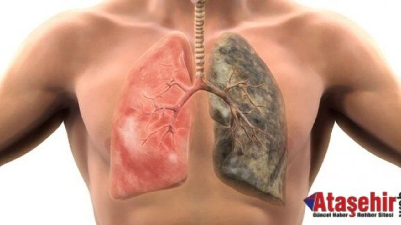 AKCİĞER KANSERİNDEN KORUNMAK İÇİN SİGARASIZ HAYATI SEÇİN