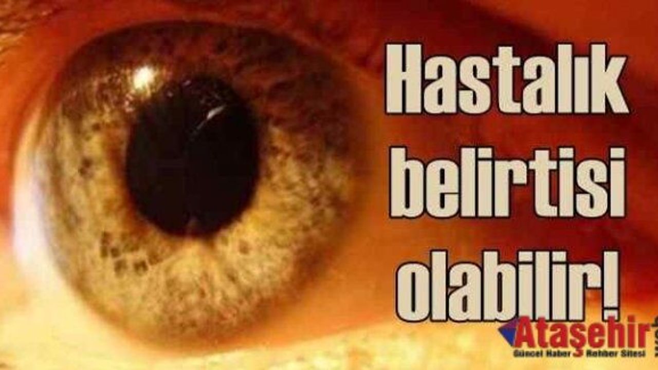 Açık göz renginde sarı nokta hastalığı riski daha fazla
