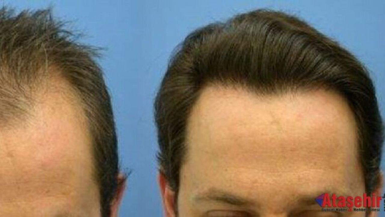 SAÇ EKİMİNDE DOĞRU BİLİNEN 7 YANLIŞ