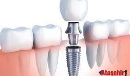 Diş İmplantları: Gülümseme Koruyucularınız