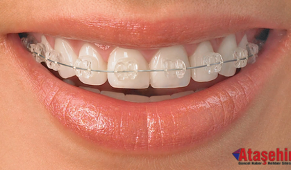 Estetik Diş Hekimliğinde Ortodonti