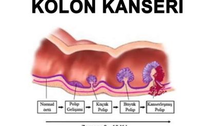 Gizli Tehlike: Kolon Kanserinde Yaş Sınırı 30’lara Kadar Düştü!