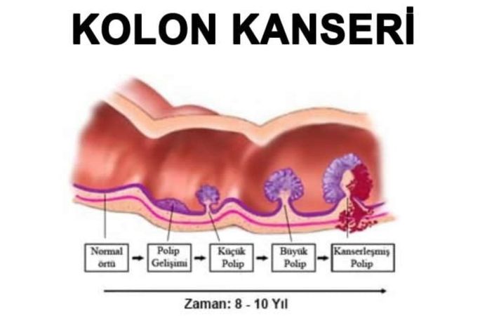 Gizli Tehlike: Kolon Kanserinde Yaş Sınırı 30’lara Kadar Düştü!