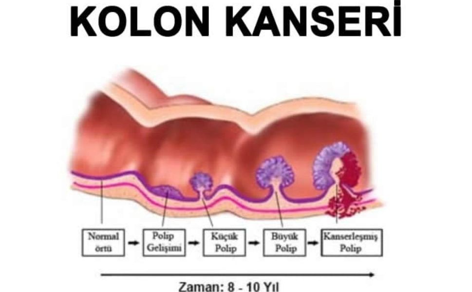 Gizli Tehlike: Kolon Kanserinde Yaş Sınırı 30’lara Kadar Düştü!